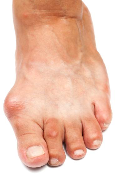 arthrose déformante du pied 